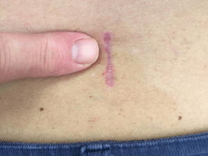 minimal scar from lumbar minimally invasive surgery