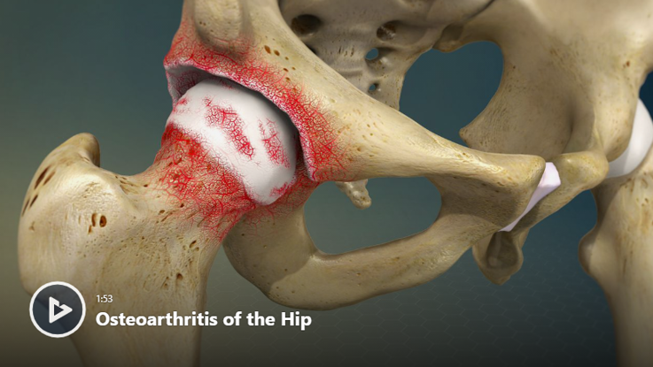 Treatment of Osteoarthritic Change in the Hip―Joint Preservation or Joint Replacement?（ハードカバー） Treatment of Osteoarthritic Change in the Hip: Joint