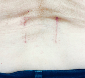 2 inch scar from from minimally invasive lumbar fusion