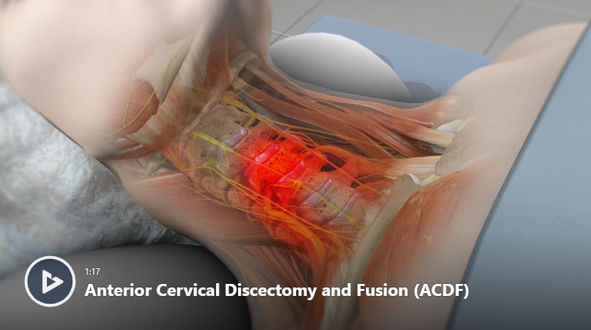 Anterior Cervical Discectomy and Fusion (ACDF) Video | Newport ...