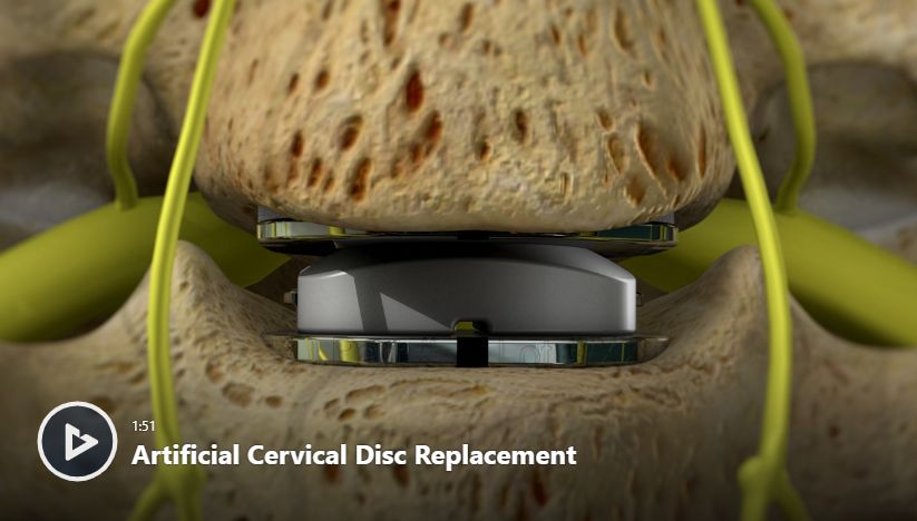 Artificial Cervical Disc Replacement Video | Newport Orthopedic Institute