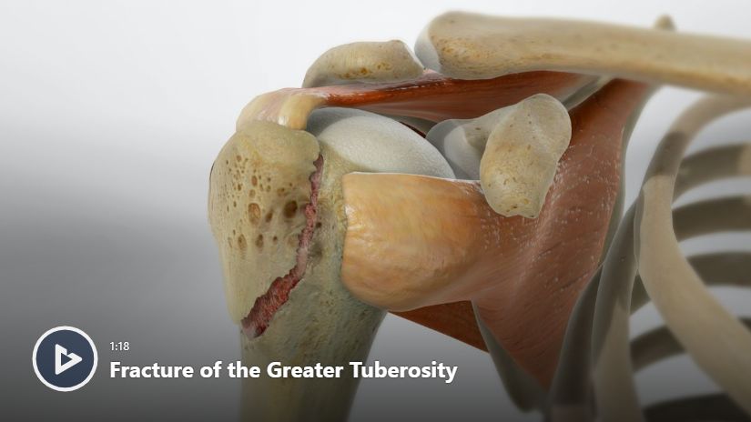 Fracture of the Greater Tuberosity Video | Newport Orthopedic Institute