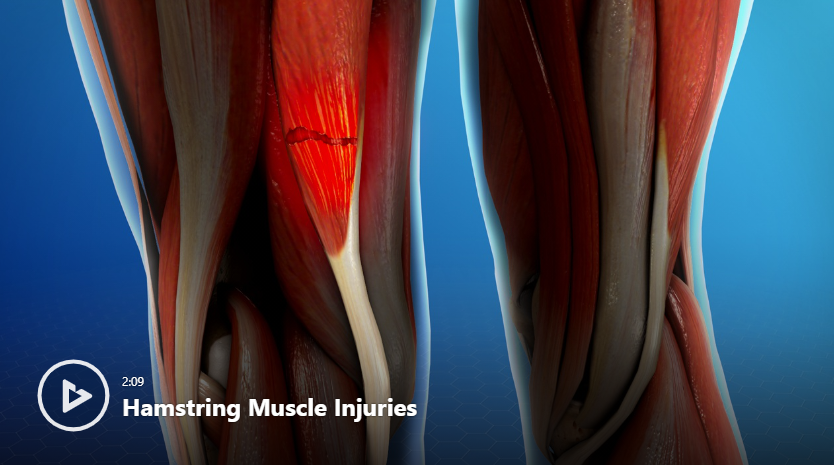Hamstring Inmotion Injury Hamstring Muscle Injuries Video | Newport Orthopedic Institute