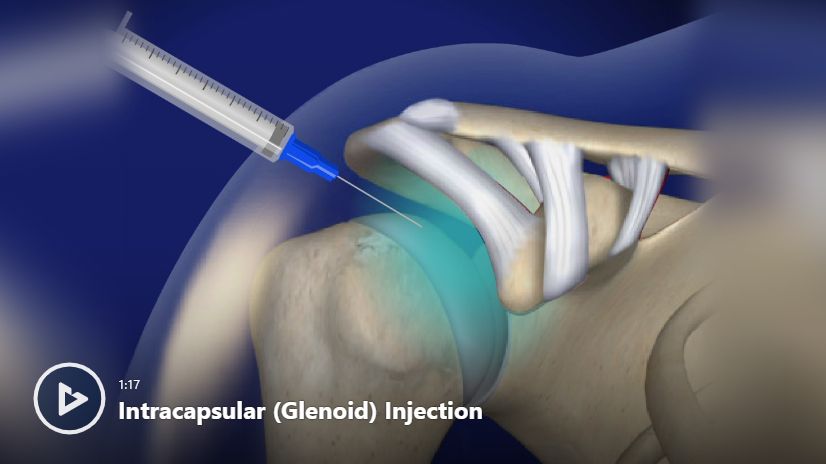 Intracapsular (Glenoid) Injection Video | Newport Orthopedic Institute