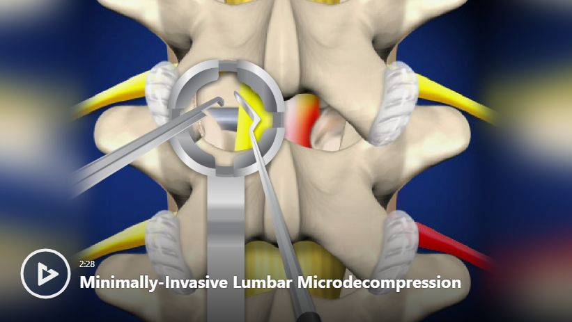Minimally-Invasive Lumbar Microdecompression Video | Newport Orthopedic ...