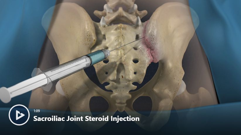 St Injection Sacroiliac Joint Steroid Injection Video | Newport Orthopedic Institute