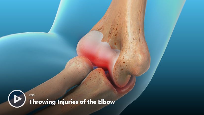 Throwing Injuries of the Elbow Video | Newport Orthopedic Institute