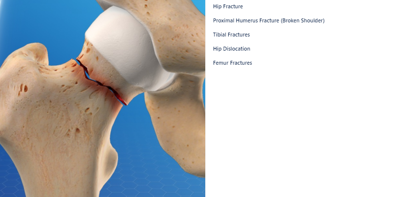 Trauma & Fracture Conditions Video | Newport Orthopedic Institute